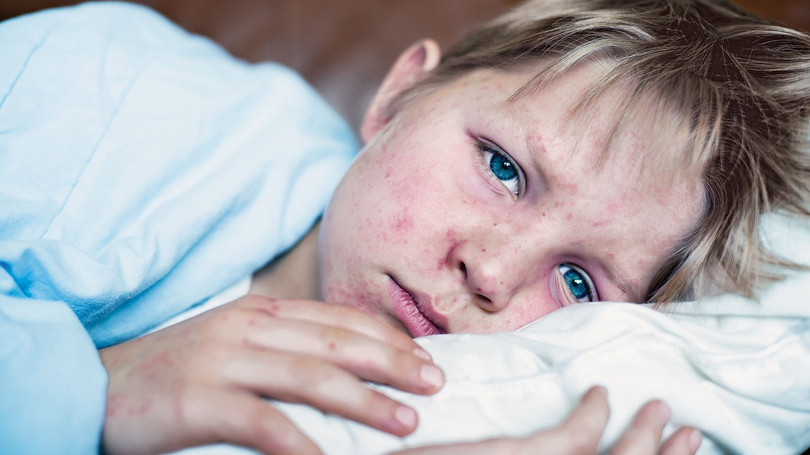 вспышка кори в казахстанском шымкенте: врачи бьют тревогу