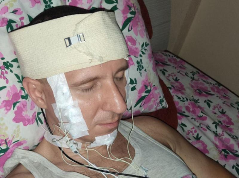 с дырой в голове: релокант из россии сделал себе трепанацию черепа в алма-ате, чтобы контролировать свои сны