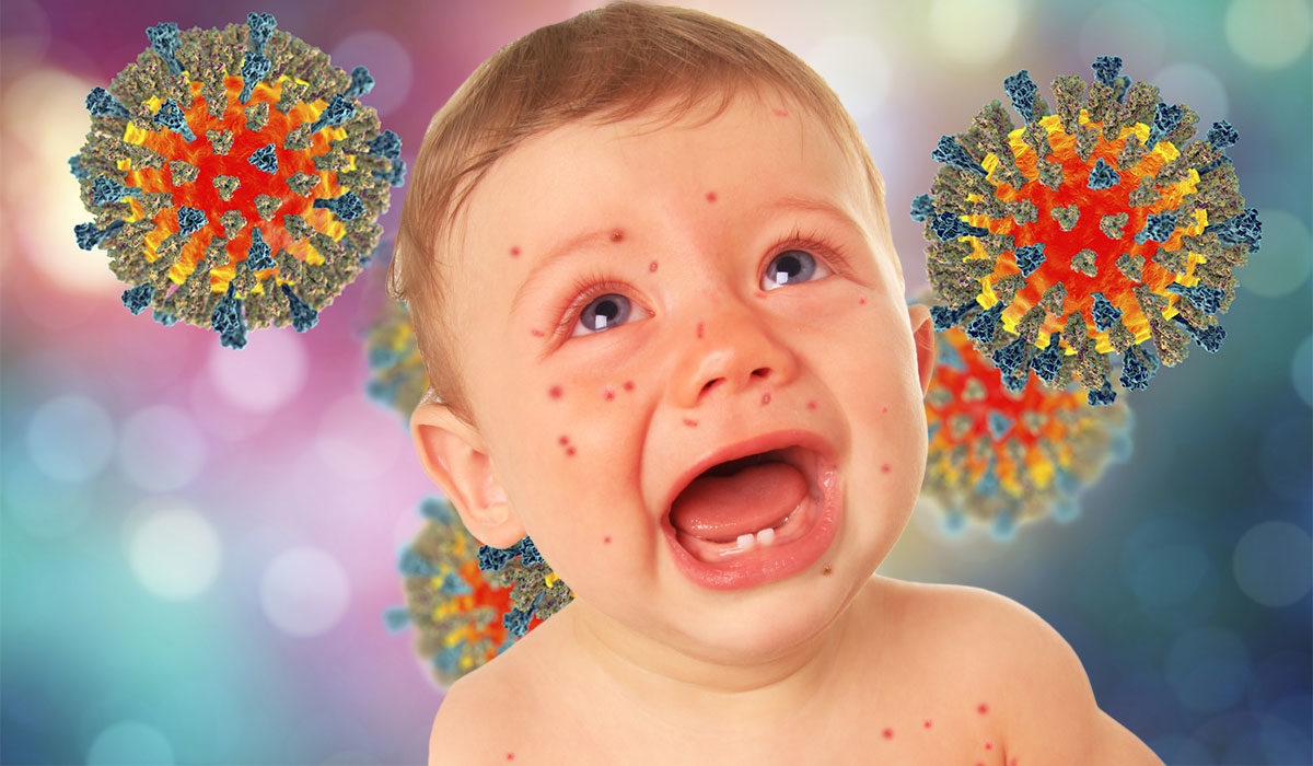 с начала 2023 года в кыргызстане зафиксирован 1 001 случай заболевания корью 