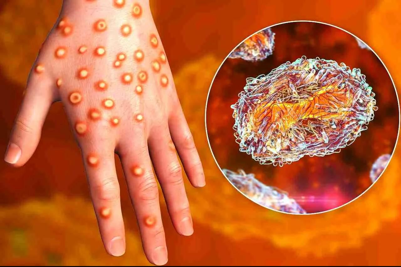 в казахстане ввели строгие меры борьбы с корью (список)