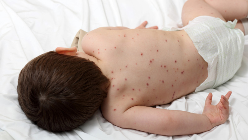 в казахстане пятеро малышей попали в реанимацию, заразившись корью
