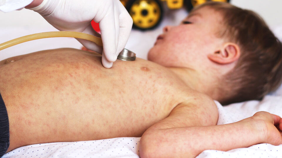 в киргизии с начала 2023 года отмечается рост случаев  кори и краснухи