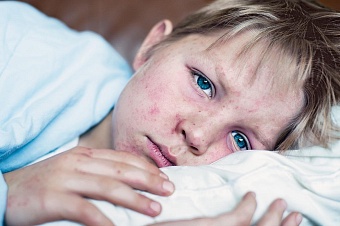 вспышка кори в казахстанском шымкенте: врачи бьют тревогу