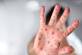 вспышка кори произошла в военном колледже в казахстане 