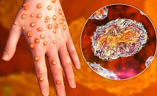 в казахстане ввели строгие меры борьбы с корью (список)