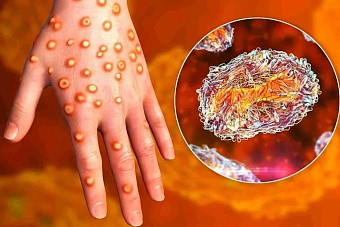 в казахстане ввели строгие меры борьбы с корью (список)