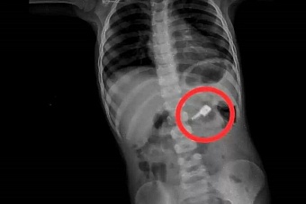 казахстанские врачи спасли ребенка, проглотившего швейные иглы