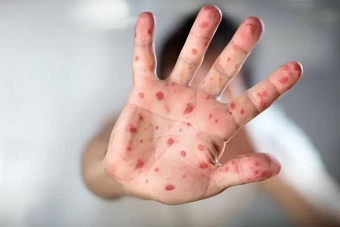 Удручающее лидерство: Казахстан занял первое место в мире по заболеваемости корью