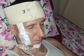 с дырой в голове: релокант из россии сделал себе трепанацию черепа в алма-ате, чтобы контролировать свои сны