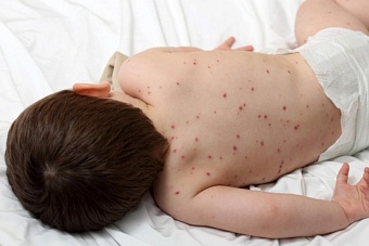 в казахстане пятеро малышей попали в реанимацию, заразившись корью