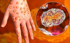 в казахстане ввели строгие меры борьбы с корью (список)