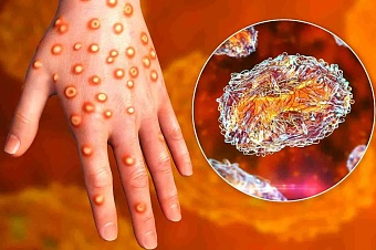 в казахстане ввели строгие меры борьбы с корью (список)