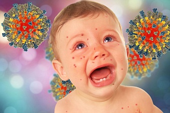 с начала 2023 года в кыргызстане зафиксирован 1 001 случай заболевания корью 