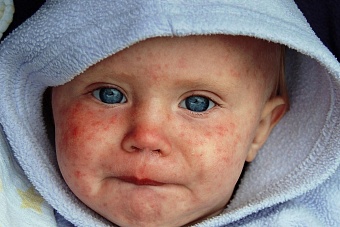 в узбекистане с начала 2023 года зафиксировали 164 случая заболевания корью